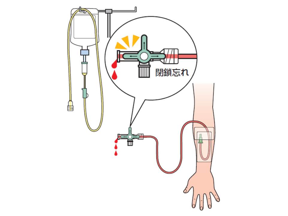 カテーテルで薬剤の未投与や血液の逆流事例など発生 三方活栓の開放 閉鎖忘れで 日本医療機能評価機構 Gemmed データが拓く新時代医療