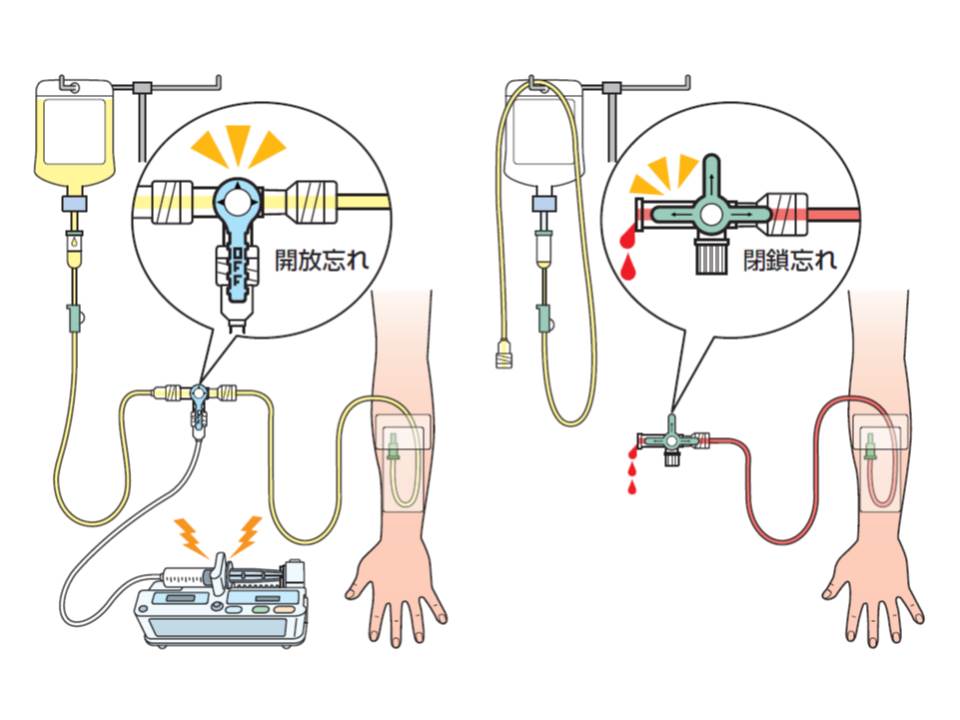 カテーテルで薬剤の未投与や血液の逆流事例など発生 三方活栓の開放 閉鎖忘れで 日本医療機能評価機構 Gemmed データが拓く新時代医療