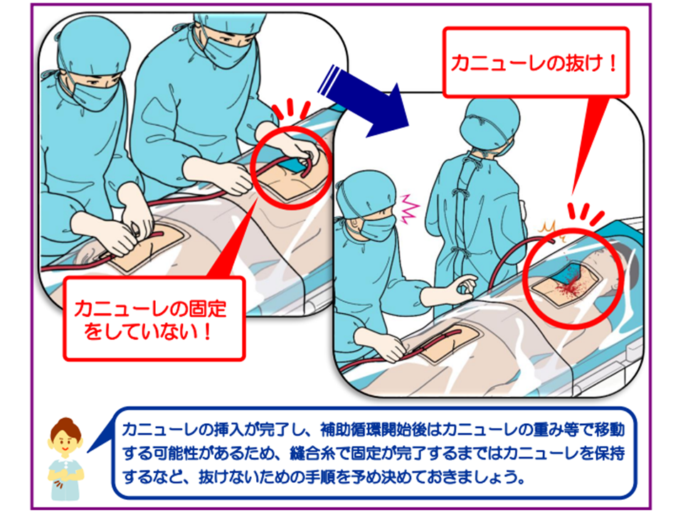 ECMO・PCPSバイブル 心臓血管外科 循環器内科 ECMO - 健康/医学